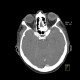 Retinal detachment, tumour of eyeball: CT - Computed tomography